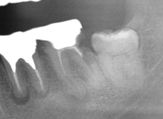 歯牙移植術